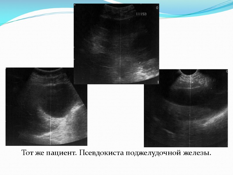 Тот же пациент. Псевдокиста поджелудочной железы.